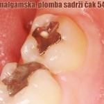 Plomba-amalgam OTROV U USTIMA: Crna, amalgamska, plomba sadrži čak 54% ŽIVE !