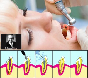 Smrtna opasnost u popravljenim zubima: Otkrivena užasna istina o vađenju živaca