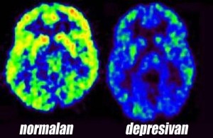 Što depresija radi vašem mozgu i kako je se riješiti?