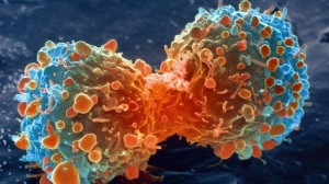 MAGNETSKA REZONANCA NAPOKON OTKRILA PRAVU ISTINU: Stanice raka napreduju i rastu na rafiniranom šećeru