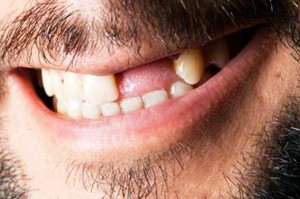 MORATE ZNATI: Evo koje bolesti uzrokuje NEREDOVNO pranje zuba!