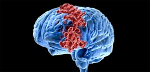 OTKRIVENO: Radioterapija raka mozga uzrokuje značajne štete na mozgu