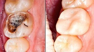 Britanski znanstvenici otkrili lijek uz pomoć kojeg vam mogu u potpunosti izliječiti pokvarene zube